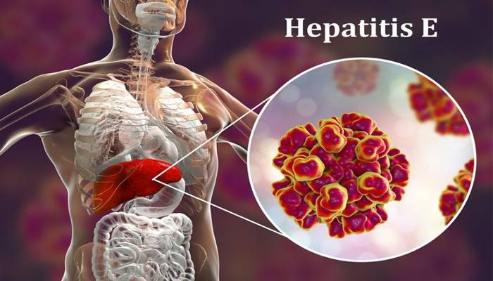 hepatitis e