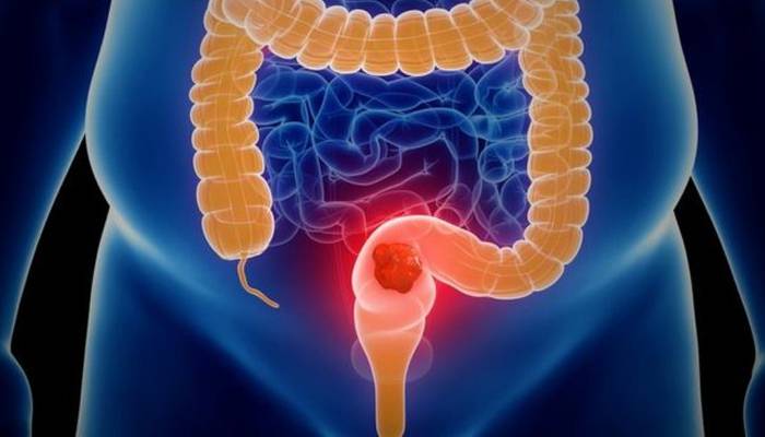 کیانوجوانوں میں بڑی آنت کاکینسربڑھنےلگا؟